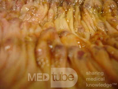 Toxic Dilatation of the Colon Superimposed pseudomembranous colitis involving the right colon (14 of 17)