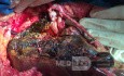 Lewostronna hepatektomia poszerona o I segment wątroby