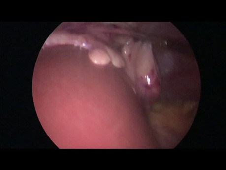 Laparoskopowa segmentektomia IVB wątroby z cholecystektomią
