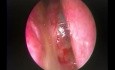 Endoskopowe usunięcie cholesterolowej cysty tylnej części przegrody nosa