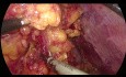 Gastrektomia laparoskopowa z powodu raka żołądka u otyłego pacjenta