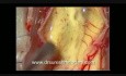 Mikrochirurgiczne usunięcie wewnątrzrdzeniowego guza zlokalizowanego w odcinku szyjnym rdzenia kręgowego