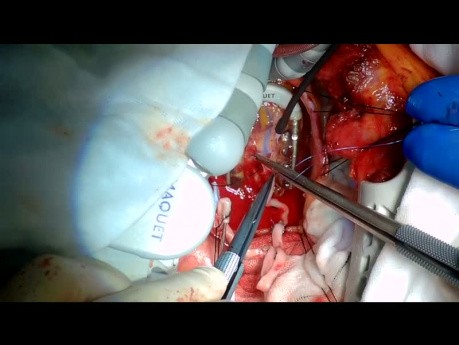 Pomostowanie aortalno-wieńcowe - reoperacja bez użycia krążenia pozaustrojowego