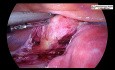 Całkowita laparoskopowa histerektomia i obustronna resekcja przydatków z mapowaniem moczowodu za pomocą angiografii indocyjaninowej (ICG)