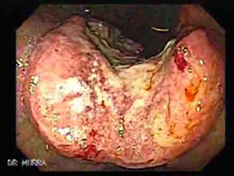 Gruczolakorak żołądka z żylakami- endoskopia (4 z 8)