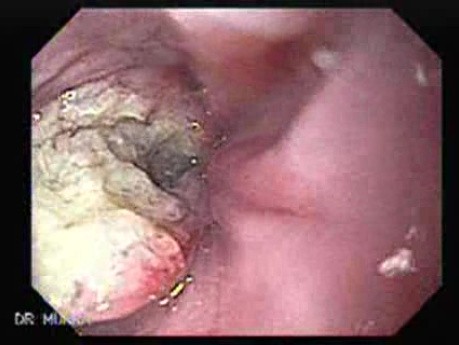 Rak płaskonabłonkowy przełyku - endoskopowy obraz guza