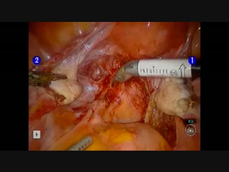 Resekcja ognisk endometriozy