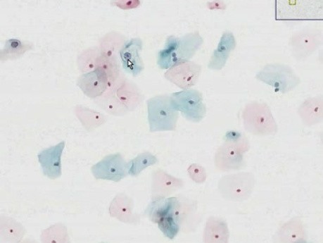 Zmiany śródnabłonkowe małego stopnia Ie - histopatologia - szyjka macicy