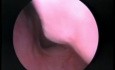 Wyrosla adenoidalne-obraz wideoendoskopii 