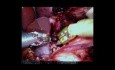 Operacja zespołu więzadła łukowatego pośrodkowego za pomocą robota