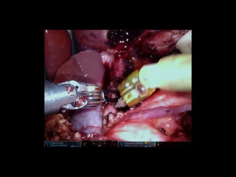 Operacja zespołu więzadła łukowatego pośrodkowego za pomocą robota