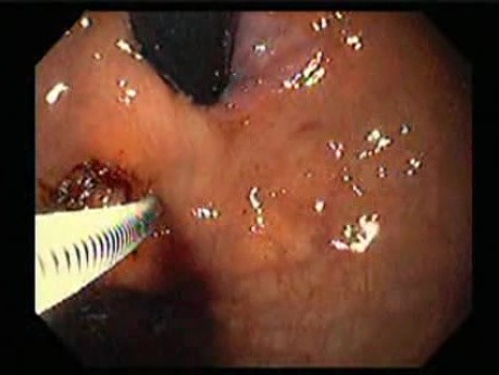 Żylaki żołądka - endoskopowa ablacja klejem cyjanoakrylowym (8 z 18)