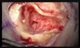 Wszczepienie implantu ślimakowego do ucha prawego