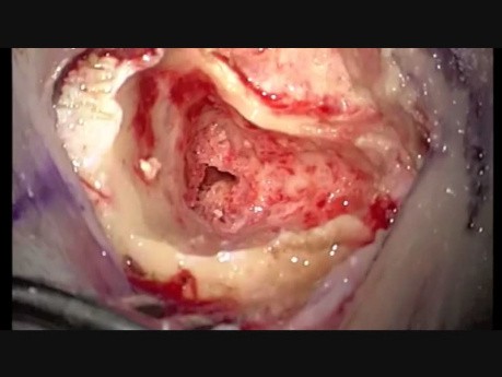 Wszczepienie implantu ślimakowego do ucha prawego
