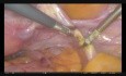 Histerektomia laparoskopowa - rozrost endometrium z atypią