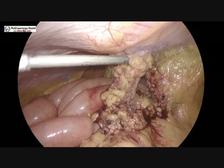 Operacja laparoskopowa nawracającej przepukliny pępkowej
