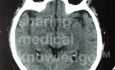Objaw hiperdensyjnej tętnicy środkowej mózgu