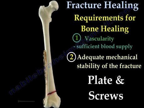 Mechanizm zrostu kości po złamaniu - część I