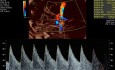 Badanie dopplerowskie tętnicy środkowej mózgu (MCA)