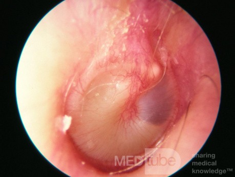 Wczesne ostre zapalenie ucha środkowego (stadium ropienia)