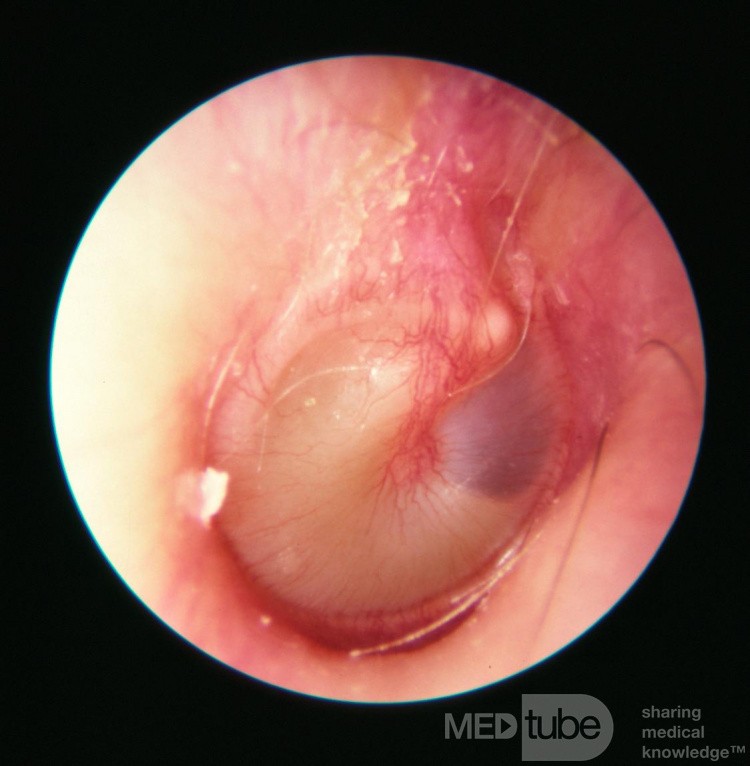 Wczesne ostre zapalenie ucha środkowego (stadium ropienia)