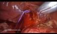 Leczenie kamicy żółciowej poprzez laparoskopową eksplorację dróg żółciowych po nieudanej endoskopowej cholangiopankreatografii wstecznej