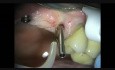 Wymiana śruby gojącej implantu stomatologicznego