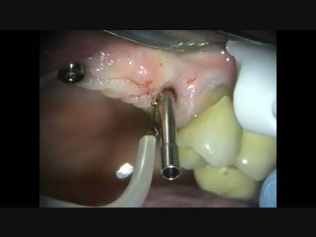 Wymiana śruby gojącej implantu stomatologicznego