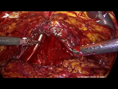 Hemostatyczne działanie matrycy TachoSil podczas robotycznej oraz laparoskopowej operacji radykalnej prostatektomii