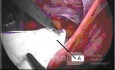 Przepuklina pachwinowa - operacja laparoskopowa
