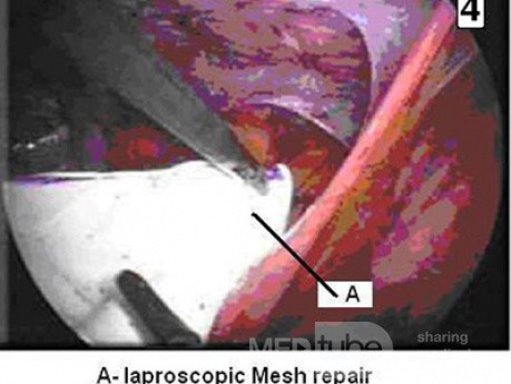 Przepuklina pachwinowa - operacja laparoskopowa