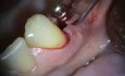 Mikrochirurgia implantologiczna: naprawa łącznika wokół implantu