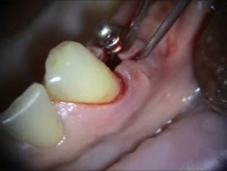 Mikrochirurgia implantologiczna: naprawa łącznika wokół implantu