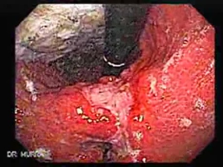 Gruczolakorak żołądka naciekający krzywiznę mniejszą  (1 z 3)