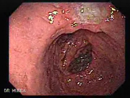 Gruczolakorak krzywizny mniejszej po gastrektomii typu Billroth II (2 z 3)