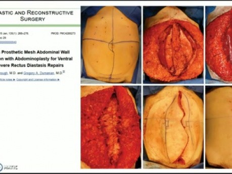 Plastyka ściany brzucha przy operacji przepukliny #2