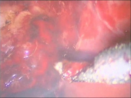 Cholecystektomia laparoskopowa - koagulowanie loży po pęcherzyku