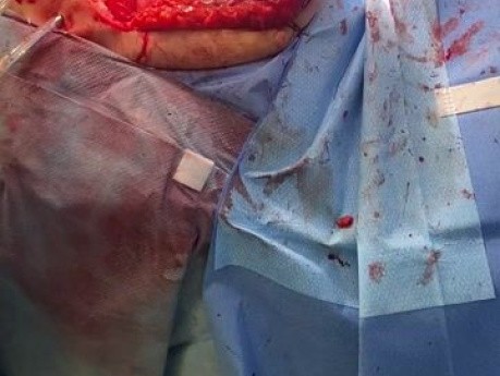 Obustronna transplantacja płuc u pacjenta ze śródmiąższową chorobą płuc - zamknięcie klatki piersiowej i wprowadzenie drenu