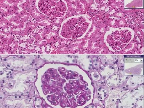 Błoniaste kłębuszkowe zapalenie nerek - histopatologia - nerka