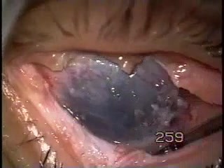 Symblephron - postępowanie operacyjne w przyrośnięciu powiek do gałki ocznej - ostrze Fugo 