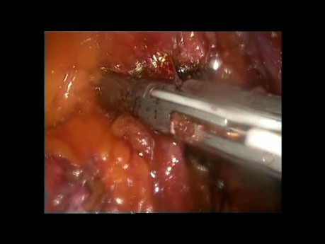 Lewostronna laparoskopowa hemikolektomia z powodu raka