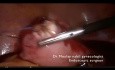 Rzucająca wyzwanie laparoskopowa miomektomia
