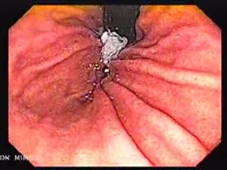 Wideoendoskopia wysokiej rozdzielczości z opcją powiększenia - trzon żołądka w inwersji endoskopowej