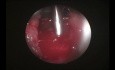 Endoskopowa adenoidektomia wspomagana mikrodebriderem i koblacją