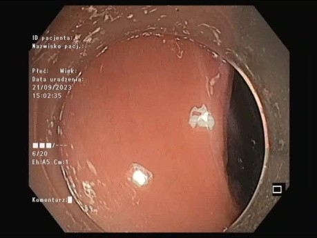 Endoskopowa resekcja zmiany odbytnicy o typie LST-G