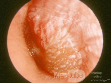 Ciężkie ostre zapalenie ucha środkowego (lewostronnie)