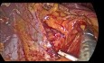 Operacja laparoskopowa skrętu żołądka