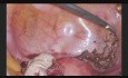 Endometrioza w laparoskopii - zastosowanie oświetlenia podczerwonego