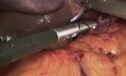 Laparoskopowa plastyka przepuklny rozworu przełykowego z operacja bariatryczną