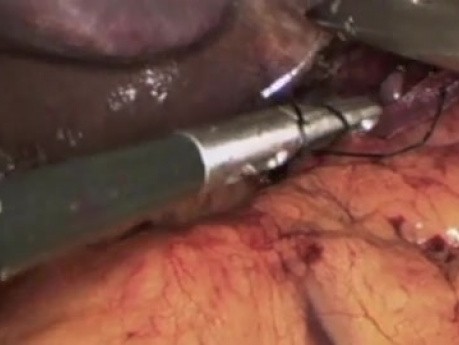 Laparoskopowa plastyka przepuklny rozworu przełykowego z operacja bariatryczną